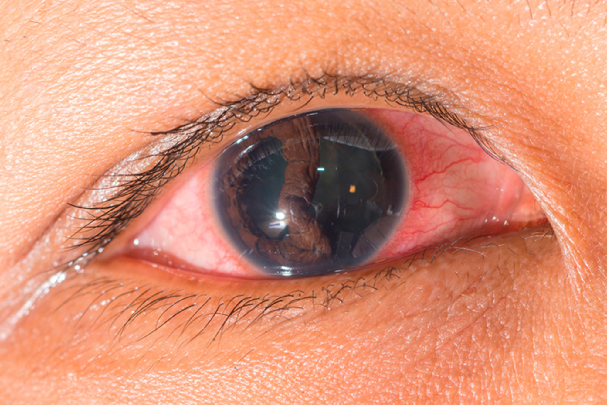 Desprendimiento de Retina